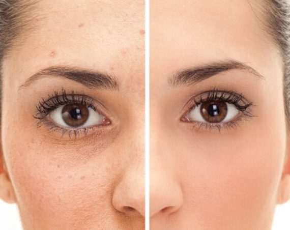 Fractional-CO2-Laser-Treatment-Risks-and-Complications-700x375