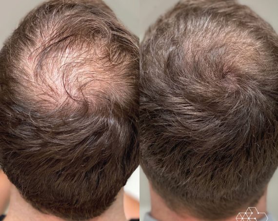 Hair-Restoration-photo-3-1